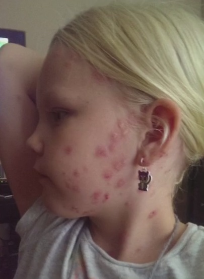 psoriasis_237784