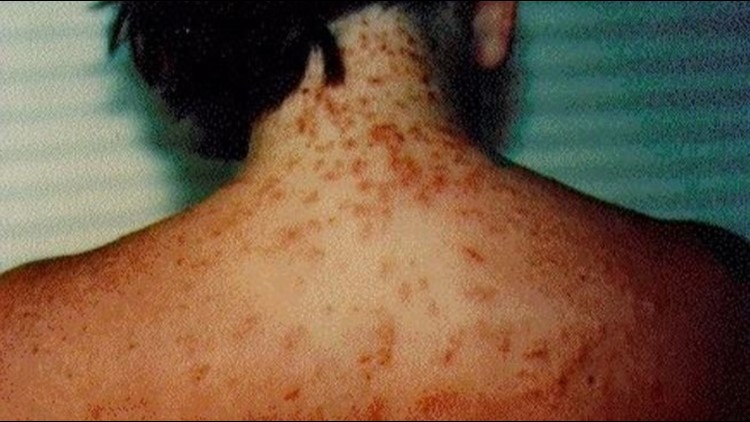 Sea lice Florida department_1530114739971.jpg.jpg
