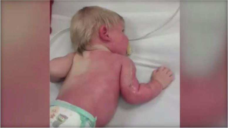 baby burn_1528280824056.JPG.jpg